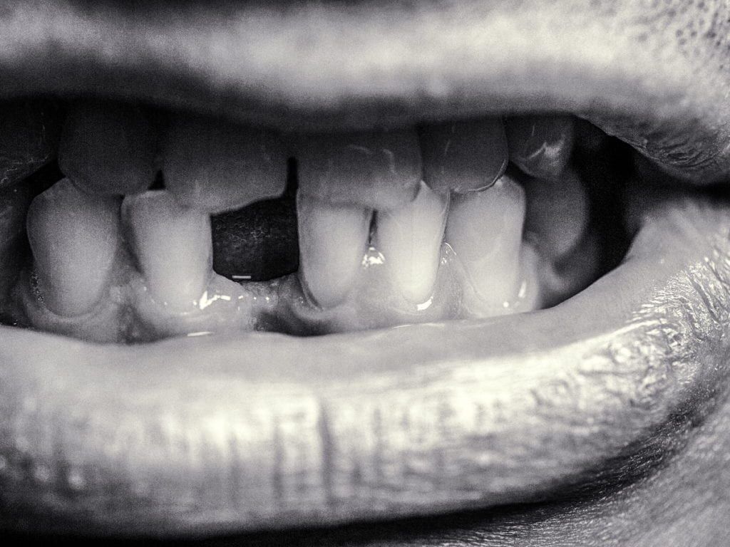 Mouth with missing tooth