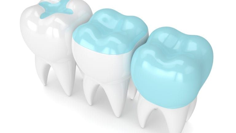 Rendered Dental Restorations