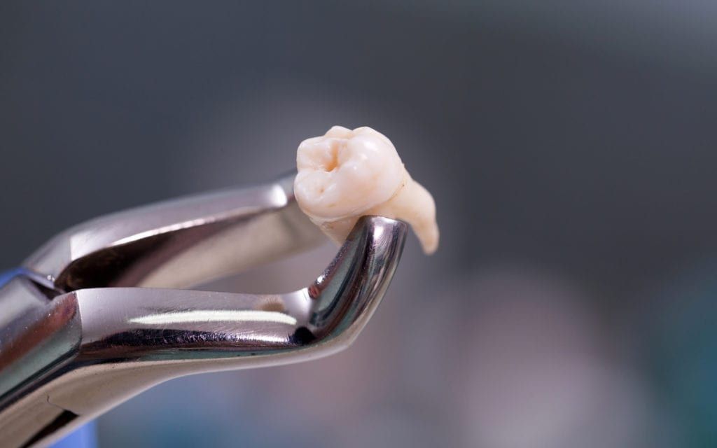 Forceps Holding Extracted Tooth