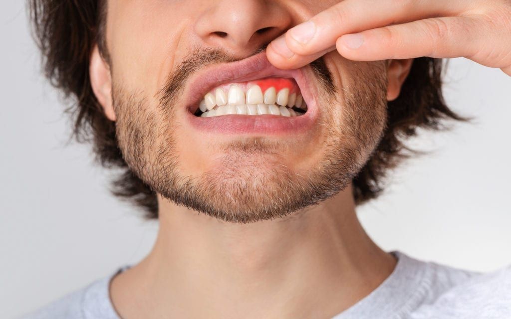 Man revealing gums for periodontal disease inspection